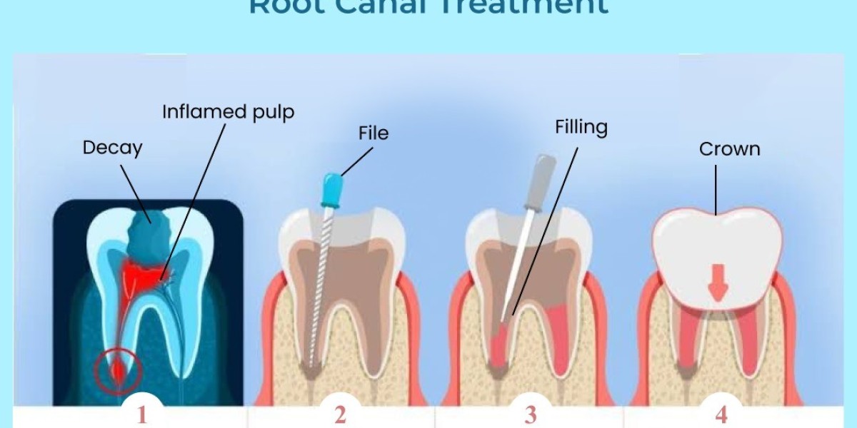 Smile Saved: Everything You Need to Know About Root Canal Treatment in Bangalore