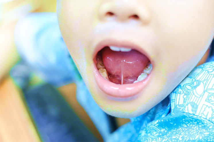 Tongue Tie Treatment and Surgery Specialist in Dubai