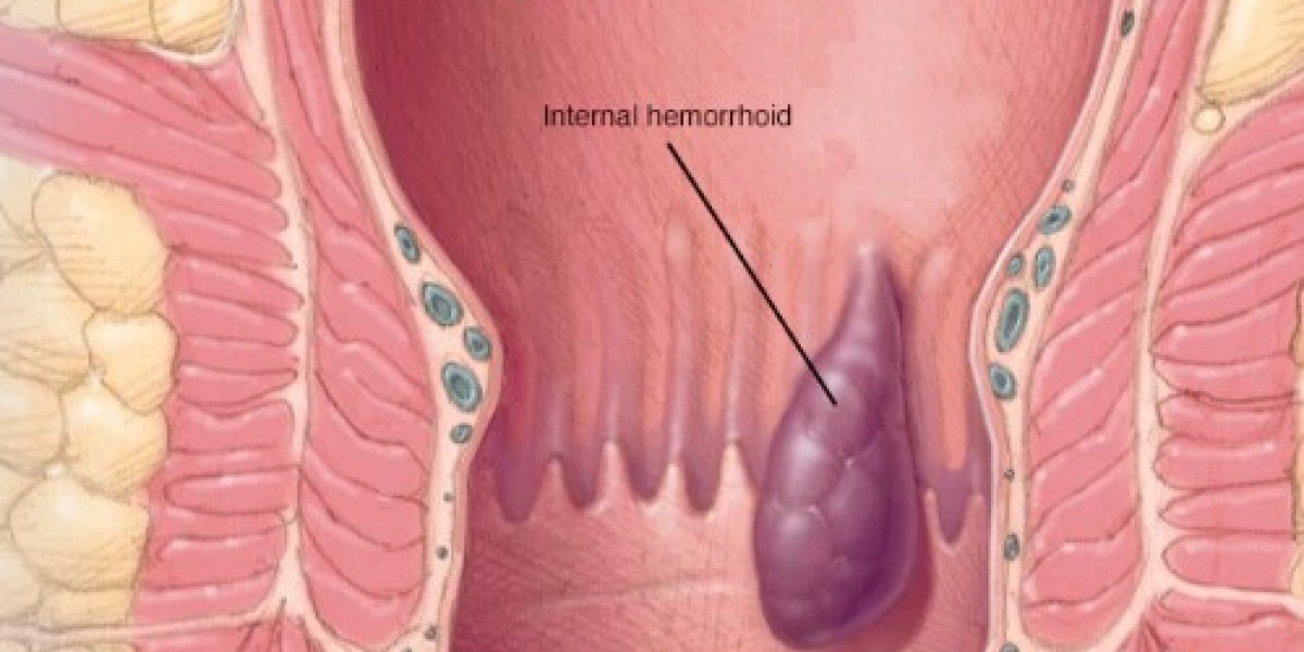 Best Fissure Treatment in Delhi – Fast Relief with Advanced Care