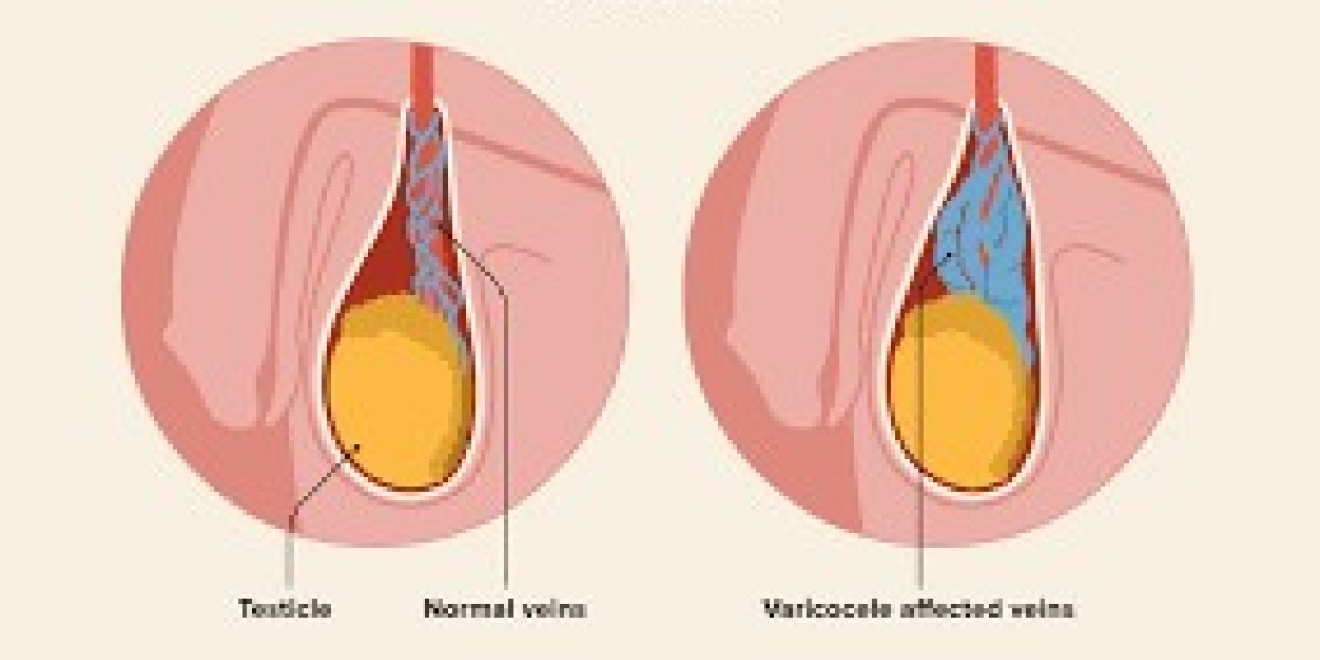 Does Hitting the Gym Lead to Varicocele? Explore the Connection