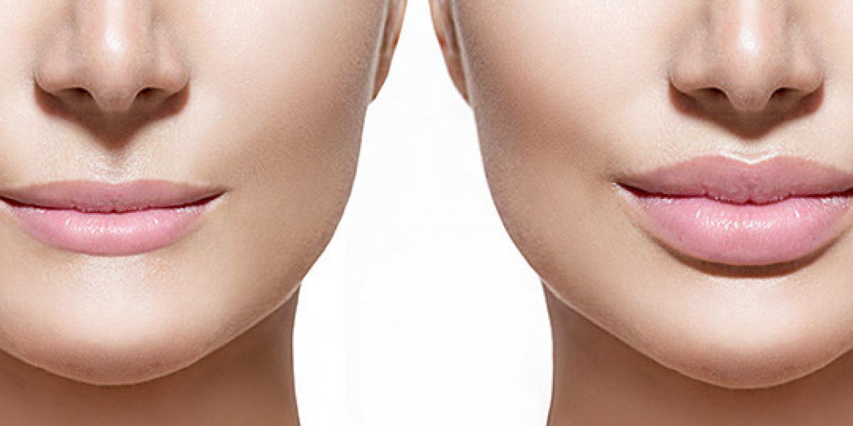 Lip Fillers in Delhi: Everything You Need to Know
