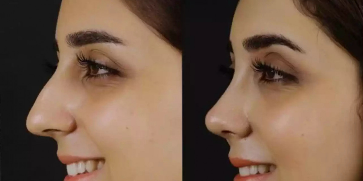 Cost and Value of Nose Deviated Septum Surgery in Dubai