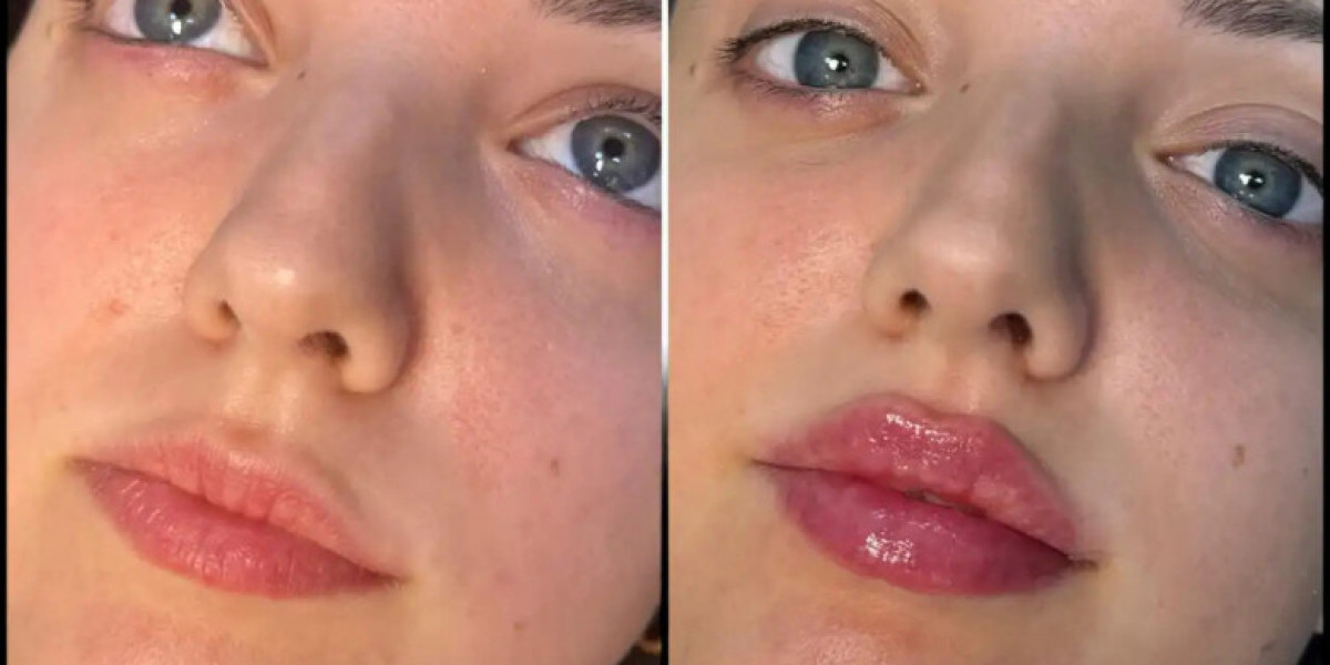 Best Plastic Surgeons in Dubai for Safe Lip Fillers