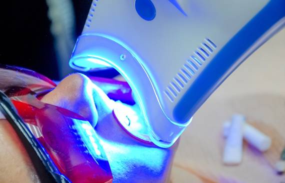 Professional Teeth Whitening in Watauga, TX | 5Star Dental