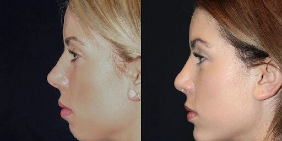Best Plastic Surgeons in dubai for Chin Fillers: What to Expect in Dubai