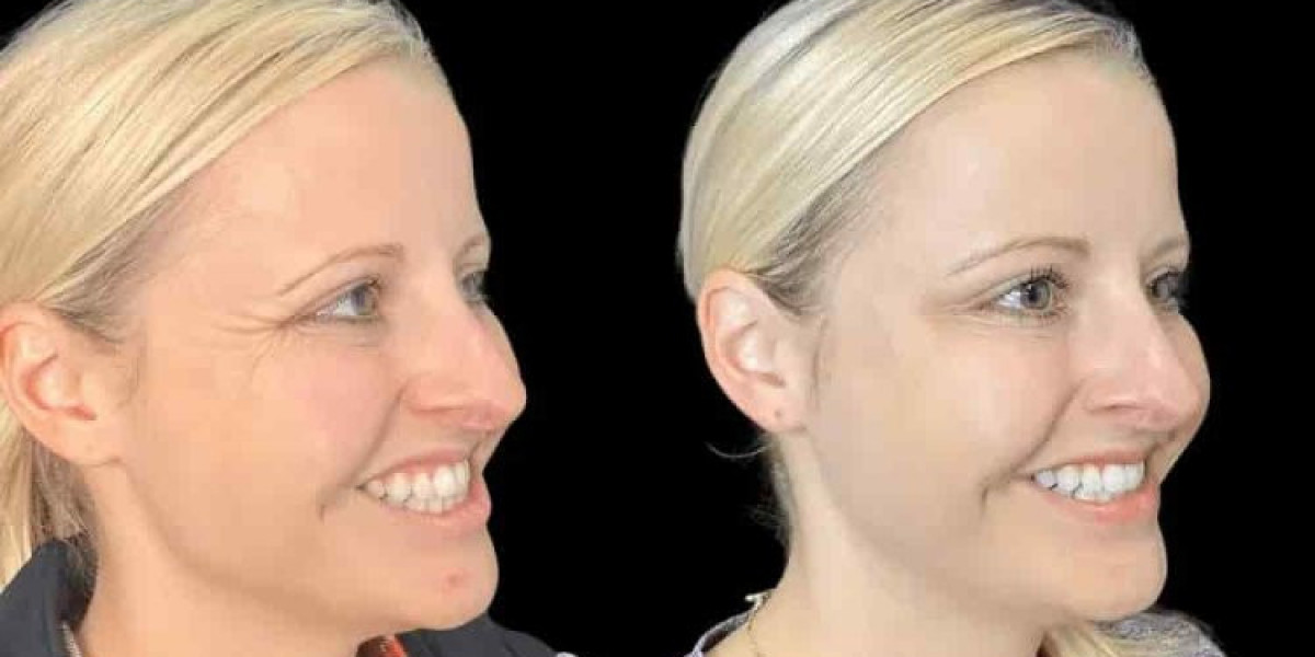 Natural Beauty Restored by the Best Plastic Surgeons in Dubai for Botox