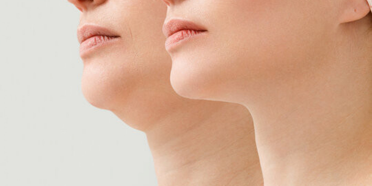 Chin Liposuction Chicago for a Sleek, Defined Jawline