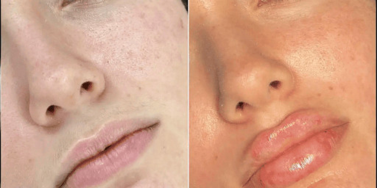 Everything You Need to Know About Fillers Treatment in Dubai