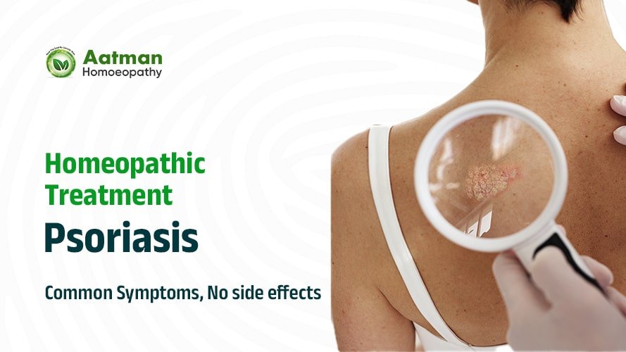 Best Homeopathic Treatment for Psoriasis
