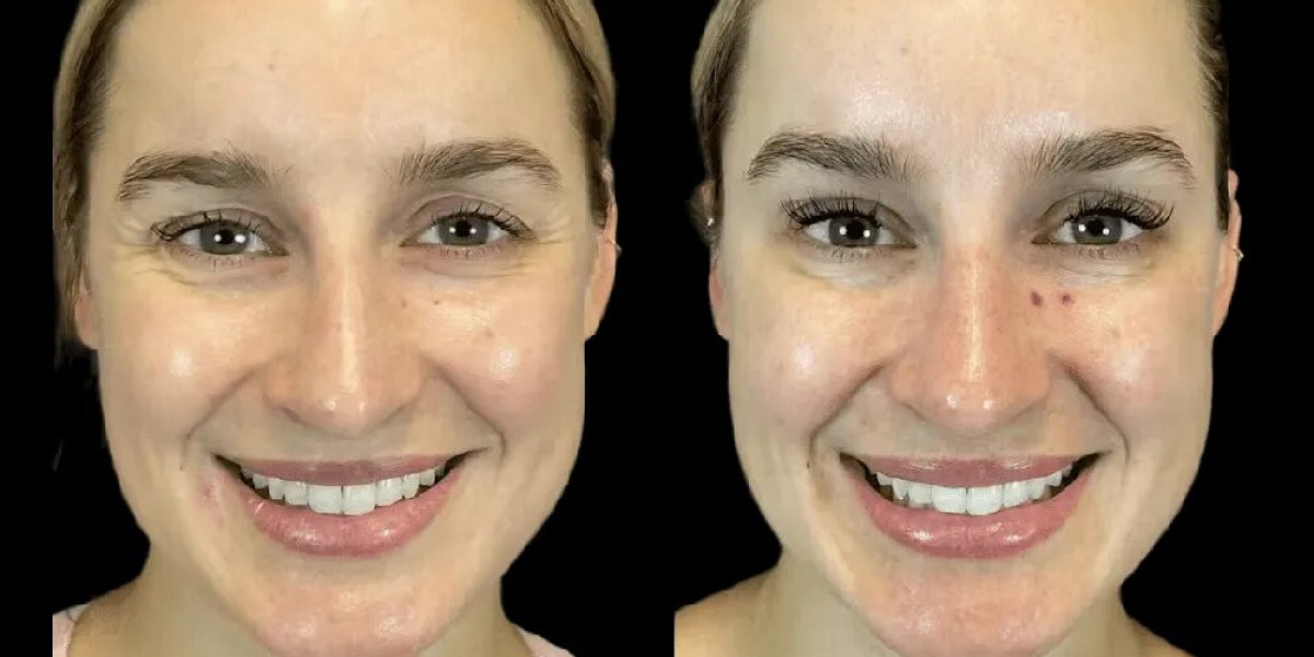 How Botox Treatment in Dubai Boosts Confidence and Enhances Natural Beauty