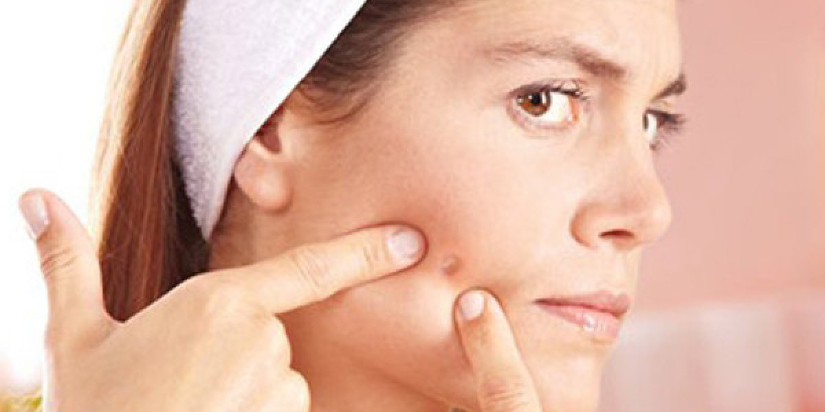 How Does Acne Treatment Differ Between Children and Adults?