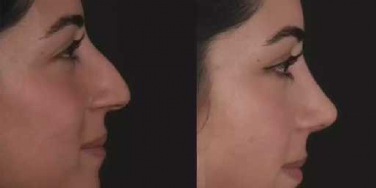 Septoplasty in Dubai Explained: Costs, Benefits And Recovery