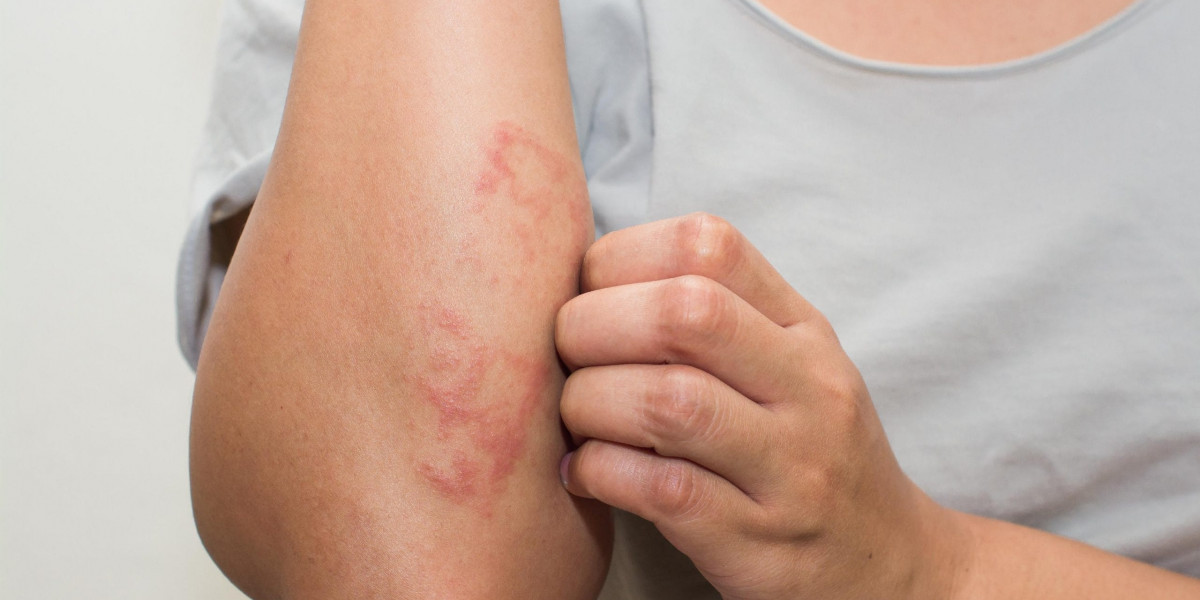 How an Allergy Doctor in Dubai Can Help Children with Chronic Allergies