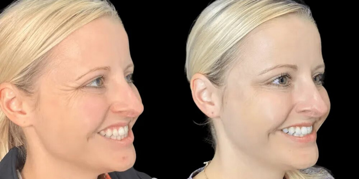 How Botox in Dubai Is Becoming the Go-To Anti-Aging Solution for Men