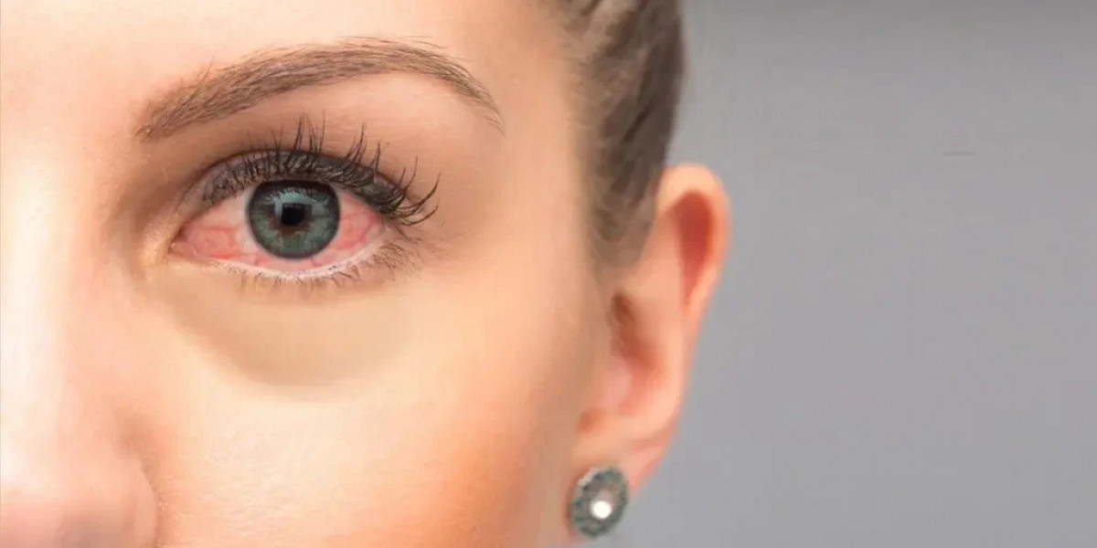 The Do’s and Don’ts After Retinal Detachment or Macular Hole Surgery