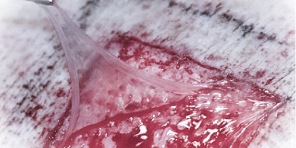 Allopatch Graft: Redefining the Future of Regenerative Wound Care
