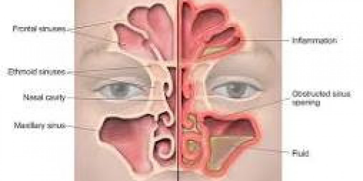 Best Doctor for Nose and Sinus Treatment – Expert Care for Relief