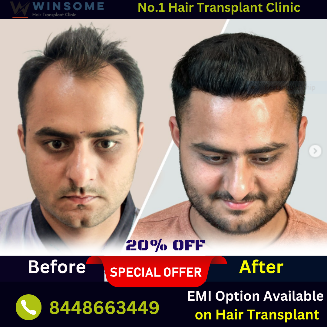 Hair Transplant Cost In Noida - Call Us More Info **** :- 8448663449