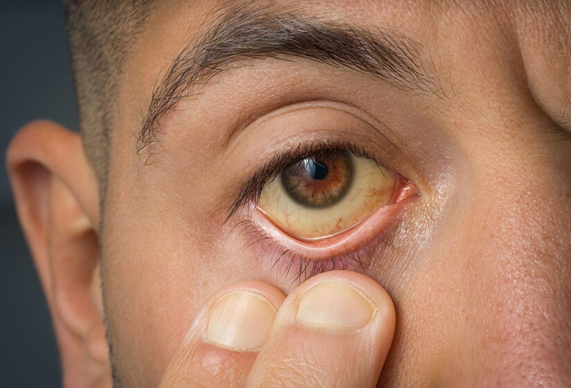 Yellow Eyes (Jaundice Eyes): Causes, Symptoms & Treatments