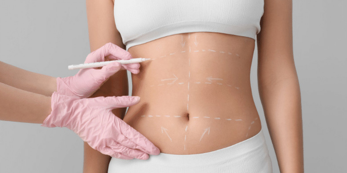 Everything You Need to Know About Liposuction Before Surgery
