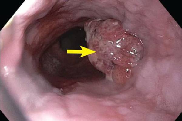 Best Esophagus Cancer Treatment in Hyderabad | Food Pipe Cancer Specialist In Hyderabad | Dr. MSS Keerthi