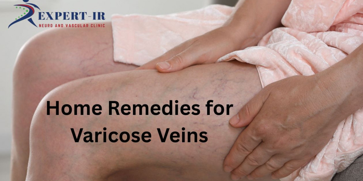 Home Remedies for Varicose Veins: Ways to Reduce Discomfort