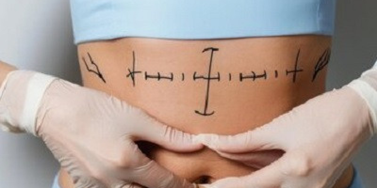 Redefine Your Body in Expert Hands With Liposuction