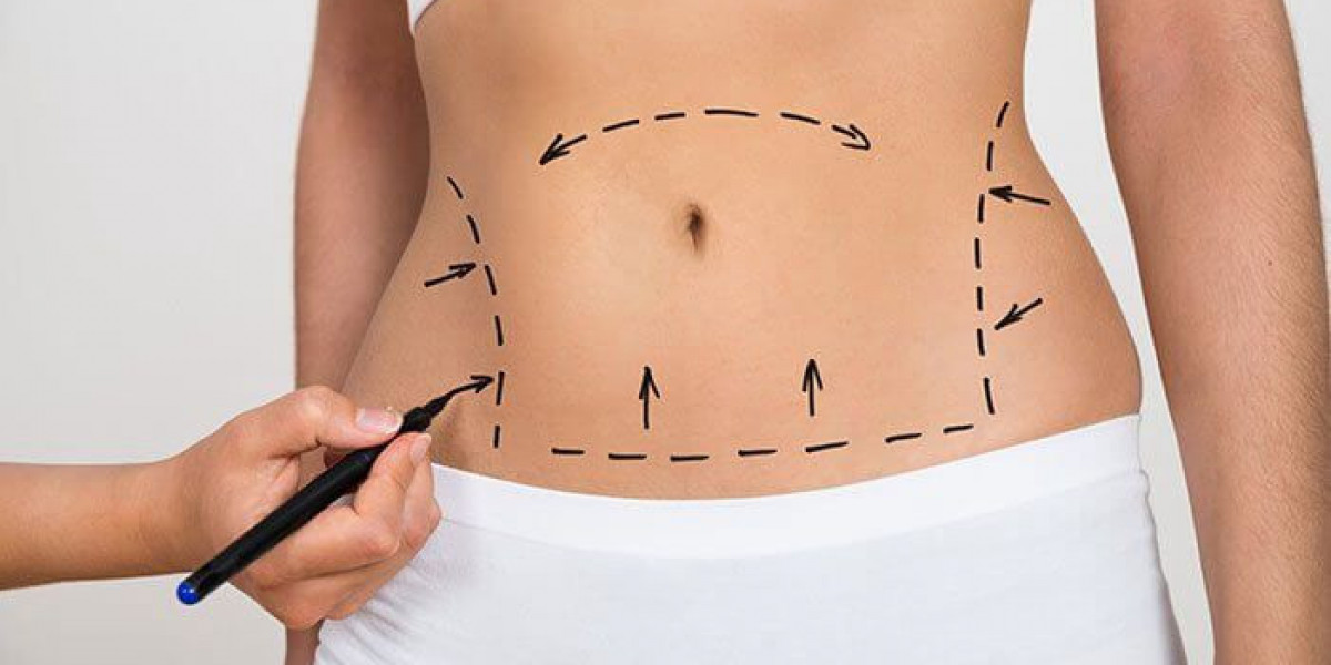 Beyond the Scale: A Master Guide to Body Sculpting and Liposuction Excellence