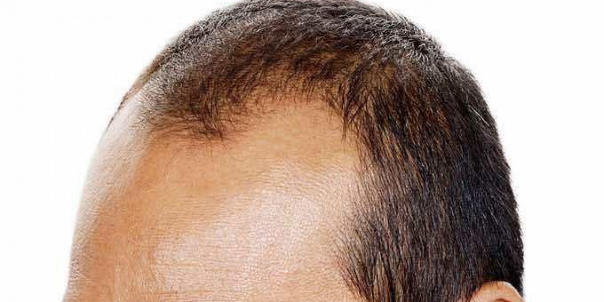 كيف تختار الطبيب المناسب لزراعة الشعر