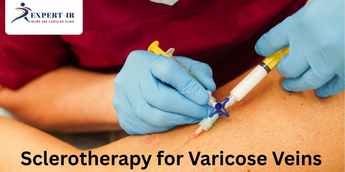 Sclerotherapy for Varicose Veins – Trust Treatment by Expert IR