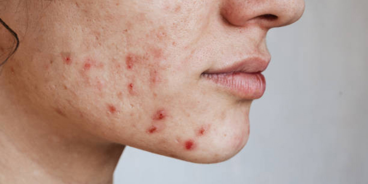 Laser Acne Treatment Innovations for Active Breakouts