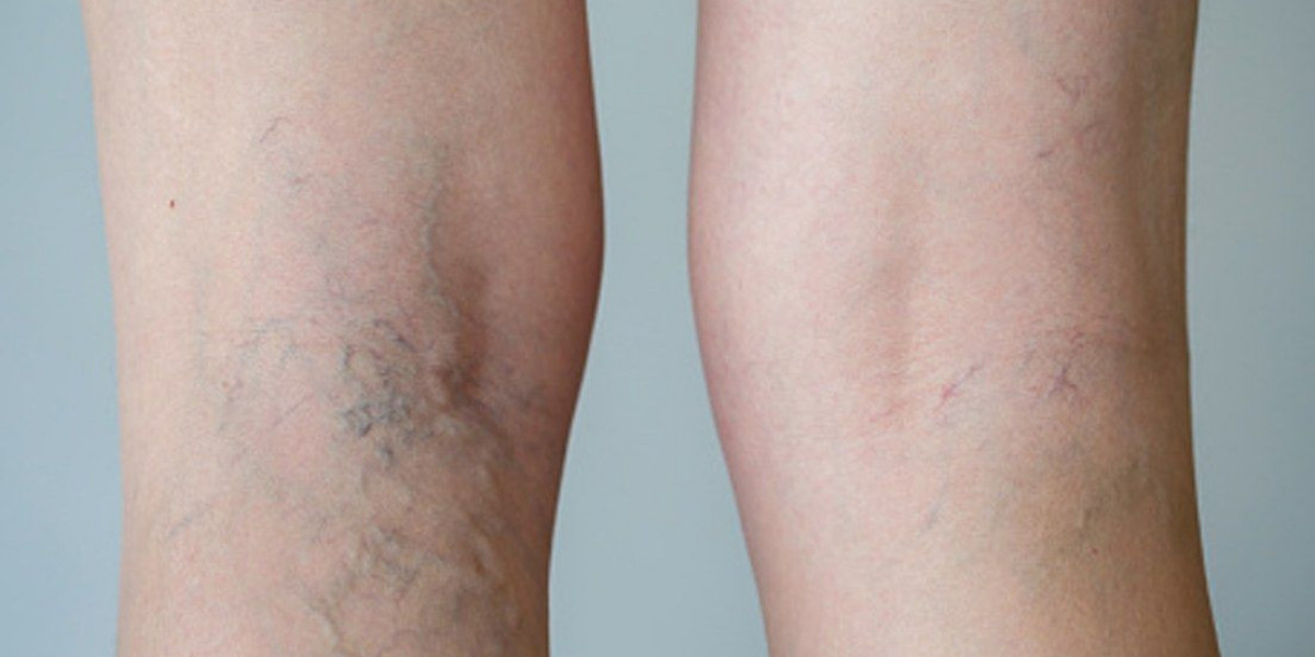 Experience Advanced Varicose Veins Treatment at Royal Clinic
