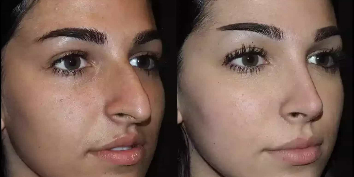 Safe and Effective Septoplasty in Dubai Explained