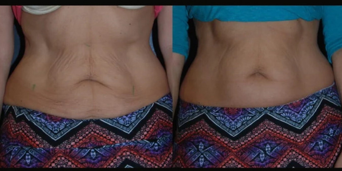 Best Doctors in Dubai Creating Confidence Through Skin Tightening