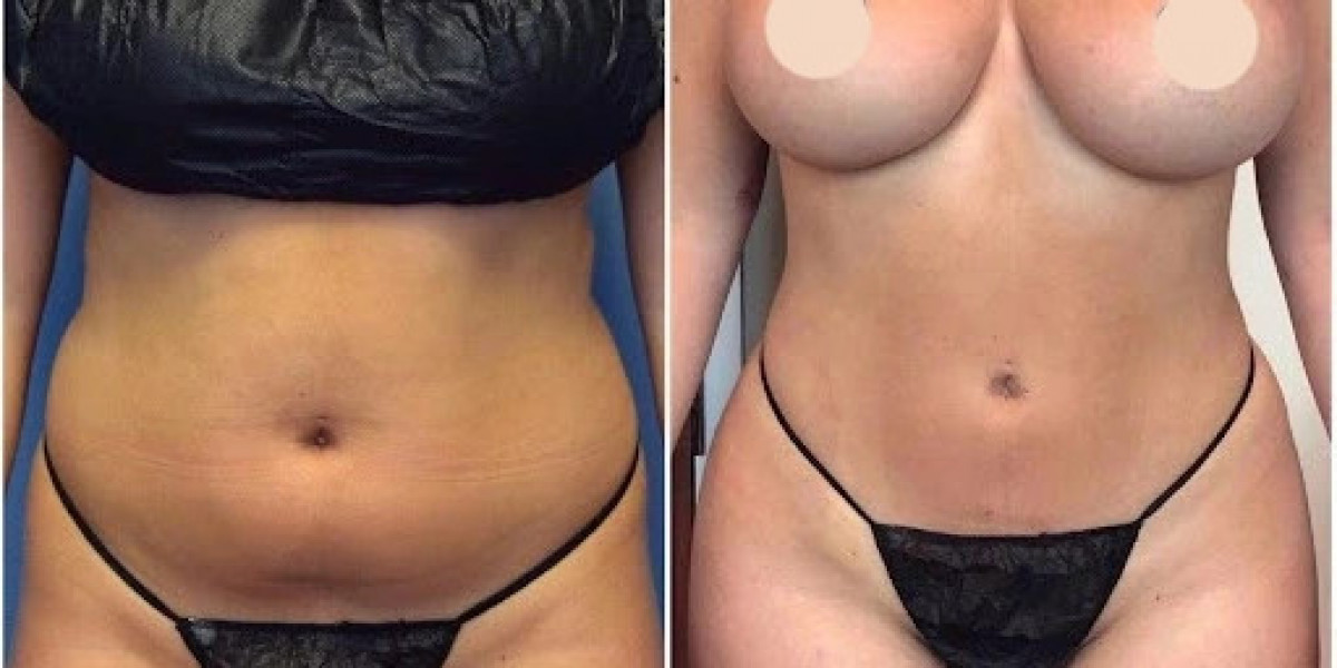 Best Doctors in Dubai Offering Non-Surgical J-Plasma Skin Solutions