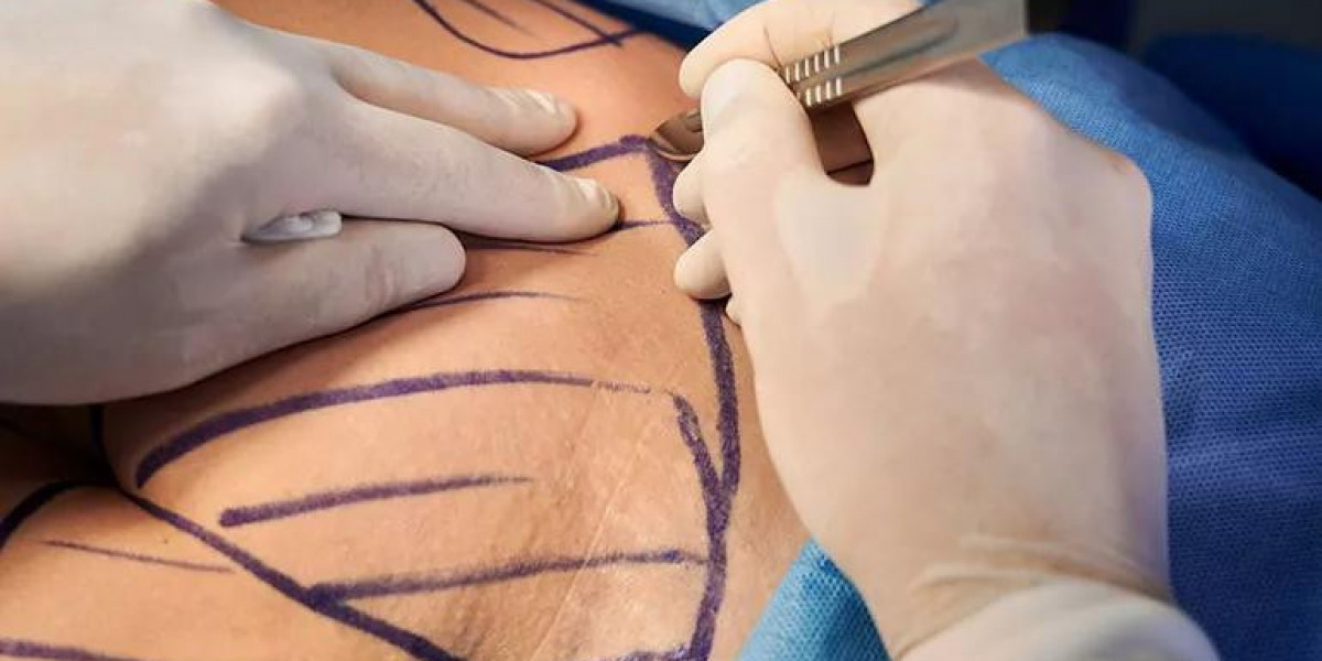 Bariatric Surgery Cost and Mental Health: Key Connections