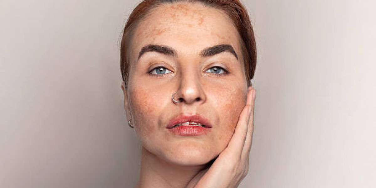 IPL Therapy as Melasma Treatment Choice