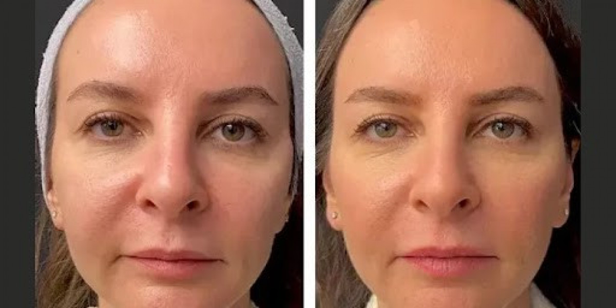 Mesotherapy in Dubai: Gentle Yet Powerful Effects