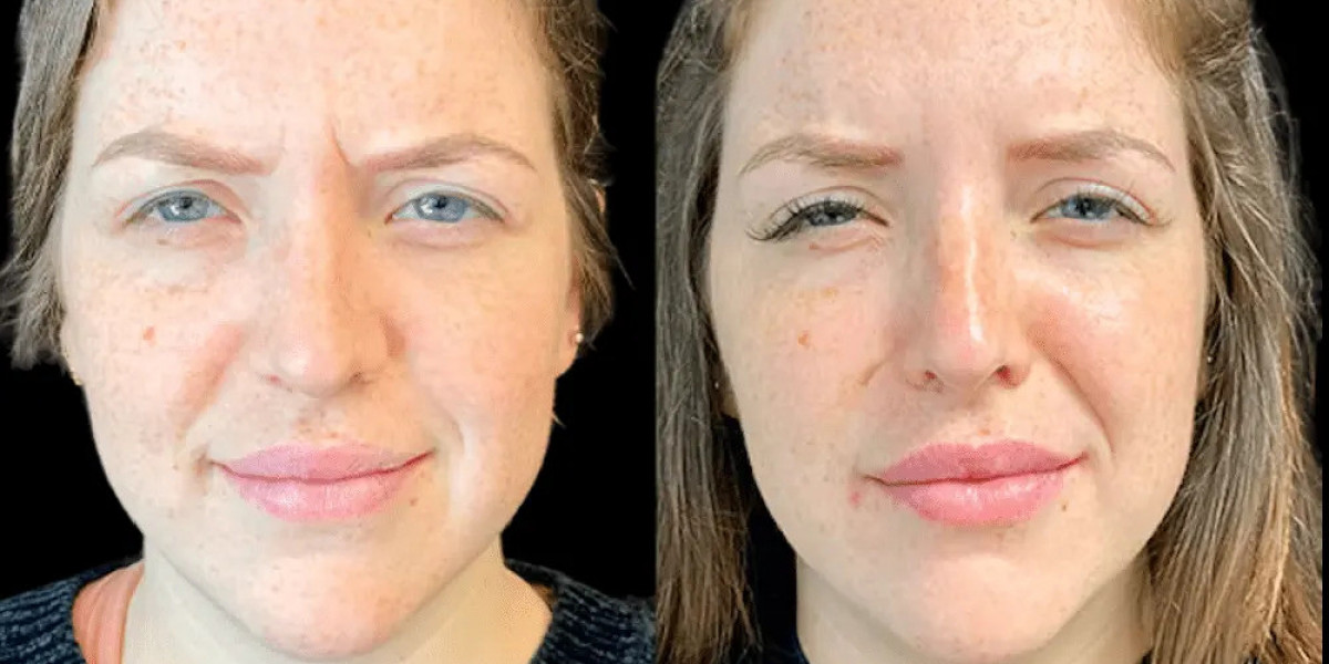 Best Doctors in Dubai for Botox: Why Medical Expertise Matters