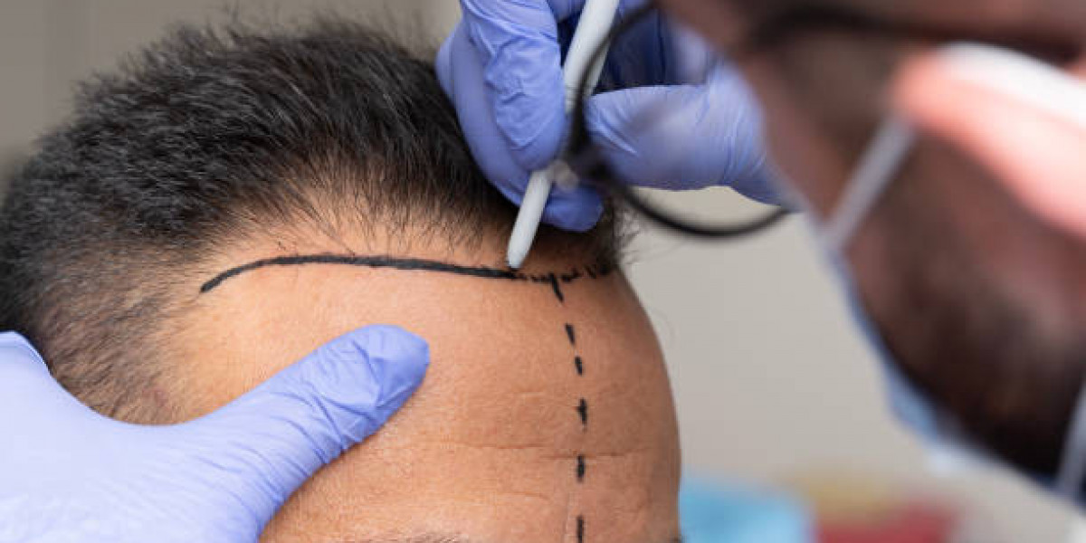 Hair Transplant for Genetic and Hormonal Hair Loss