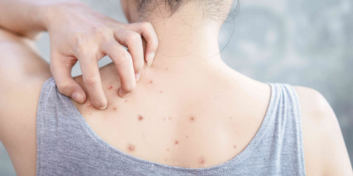 Hidden Back Acne Causes Linked to Lifestyle and Hygiene