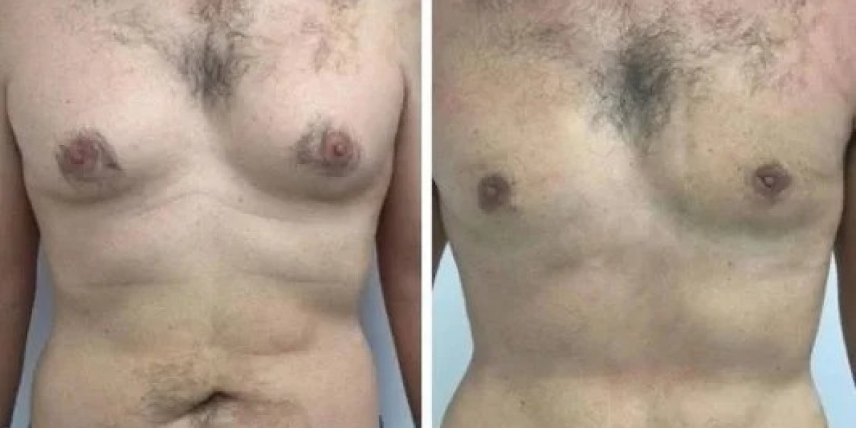 Best Gynecomastia Surgeon in Dubai Clarifies Fat and Gland Differences