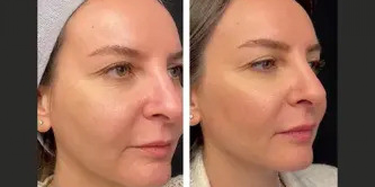 Mesotherapy Treatment in Dubai: Skin Rejuvenation Without Surgery