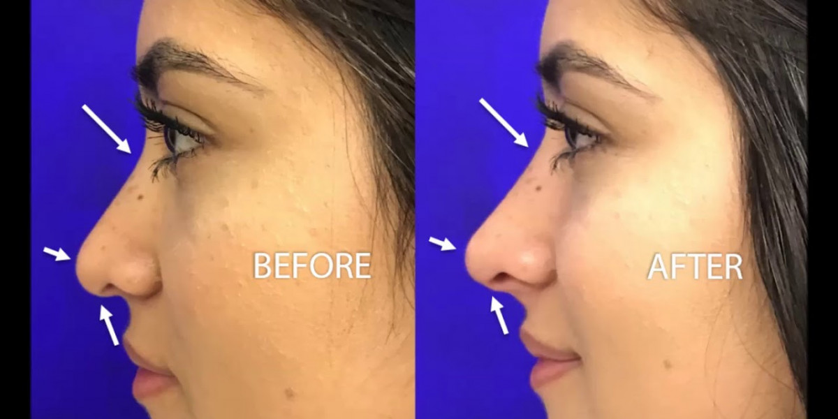 Quick & Safe Liquid Rhinoplasty for Nose Refinement Results