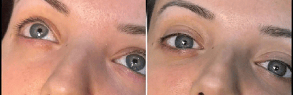 dermal fillers Cover Image