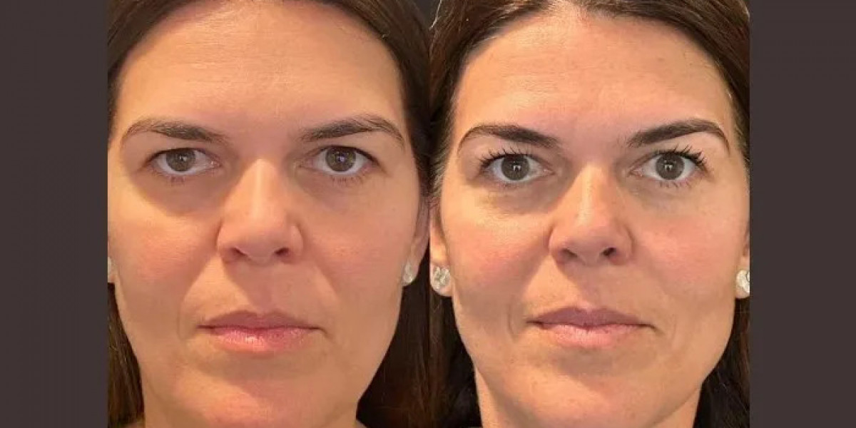 Benefits of Choosing Thread Lift in Dubai for Non-Surgical Face Lifting