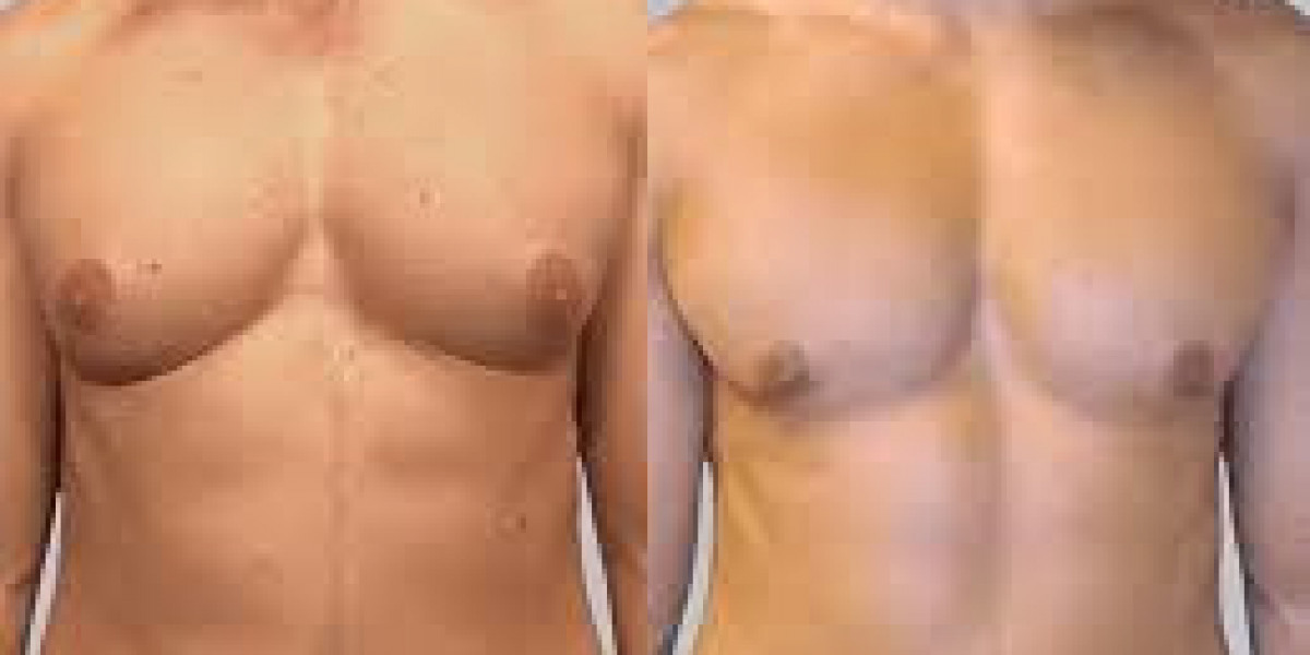 Medications That May Cause Gynecomastia: Islamabad Doctors Explain Which Works Better