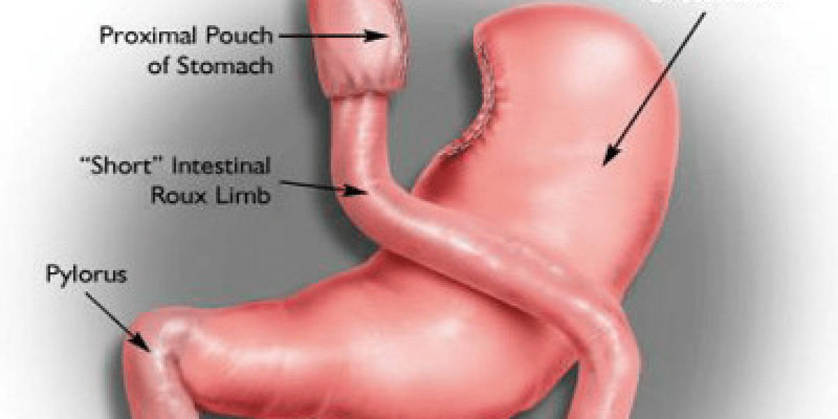 Pre-Surgery Preparation for Gastric Bypass: A Complete Medical & Lifestyle Readiness Guide