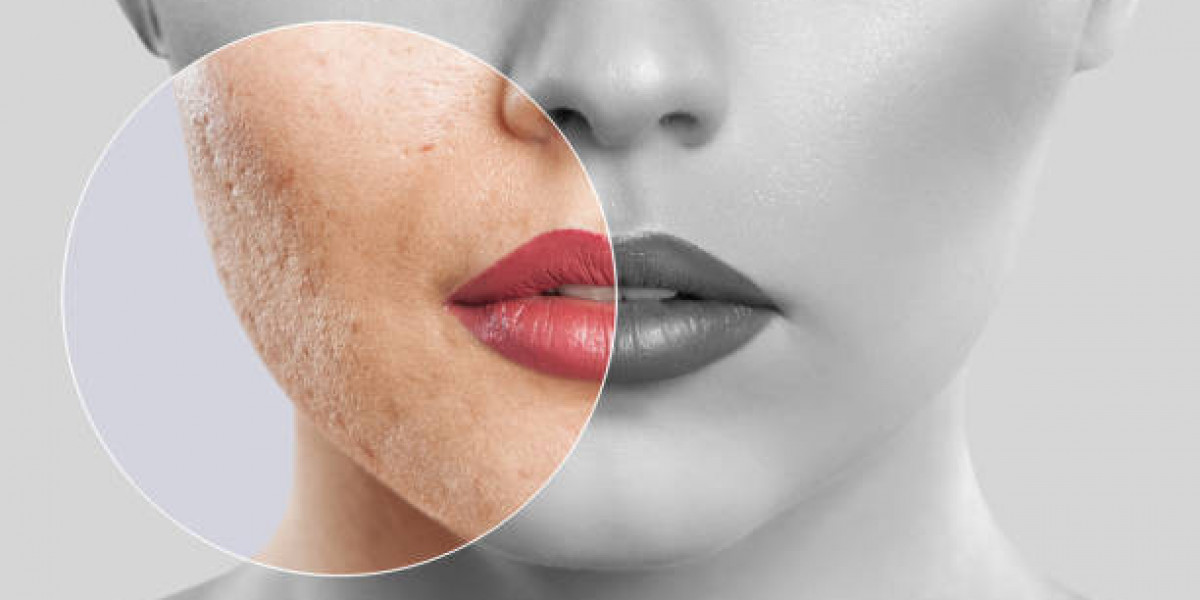 Before and After Laser Acne Treatment Transformations