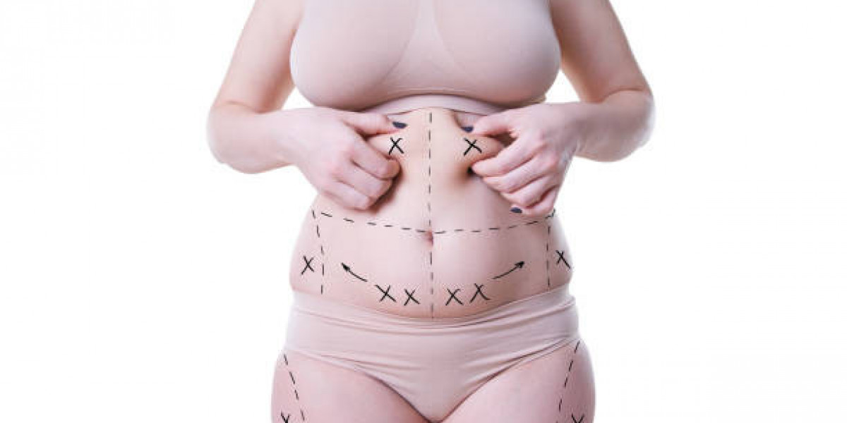 Liposuction Procedure Pairings with Tummy Tucks